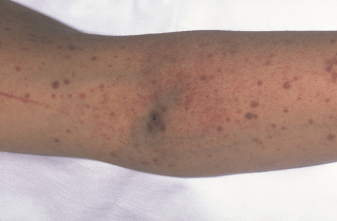 Best Hemato oncologist in Ahmedabad